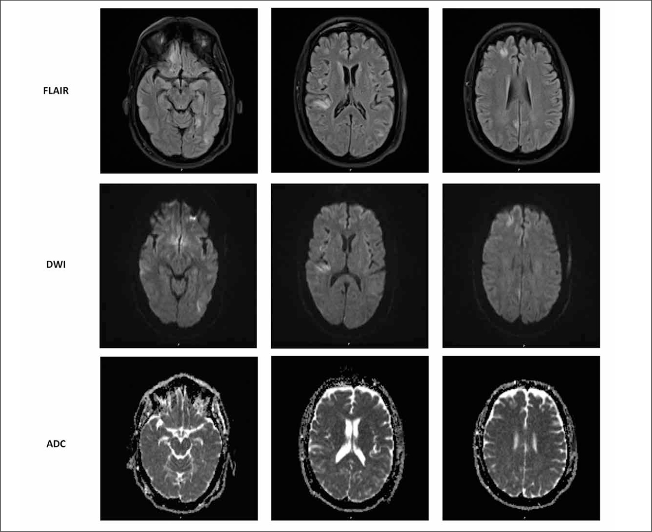 FIGUUR 1. MRI-scan van de hersenen.