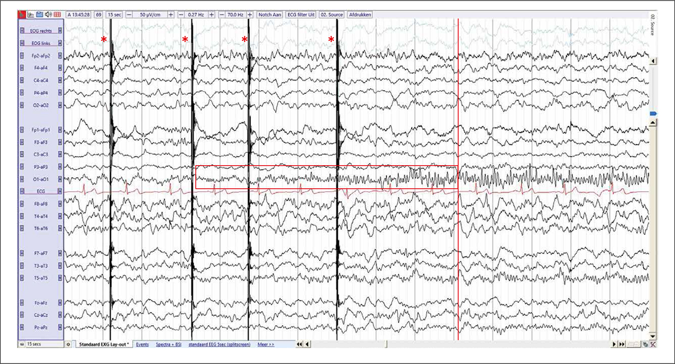 FIGUUR 2. EEG in referentiële afleiding (source, 50 μV, 15 seconden) toont een vertraagd achtergrondpatroon, over de occipitale gebieden links ontstaan van ritmische activiteit in de bèta-range (zie de rode box) die evolutie van vorm en frequentie laat zien naast spreiding.